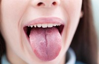 Những triệu chứng ung thư lưỡi cần biết để phòng ngừa