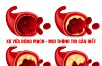 Xơ vữa động mạch - Giải pháp điều trị và phòng tránh biến chứng