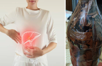 Loại rượu thuốc mà bệnh nhân đã uống dẫn đến tăng men gan.