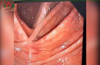 Hình ảnh nội soi phát hiện ký sinh trùng trong đại tràng bệnh nhân. Ảnh: BVCC
