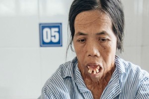 Đã gần 50 năm cô Sáu phải sống với khuôn mặt biến dạng vì tai nạn năm 6 tuổi.(Ảnh: Kênh 14).