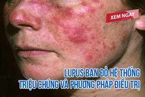 Lupus ban đỏ hệ thống – Triệu chứng và phương pháp điều trị