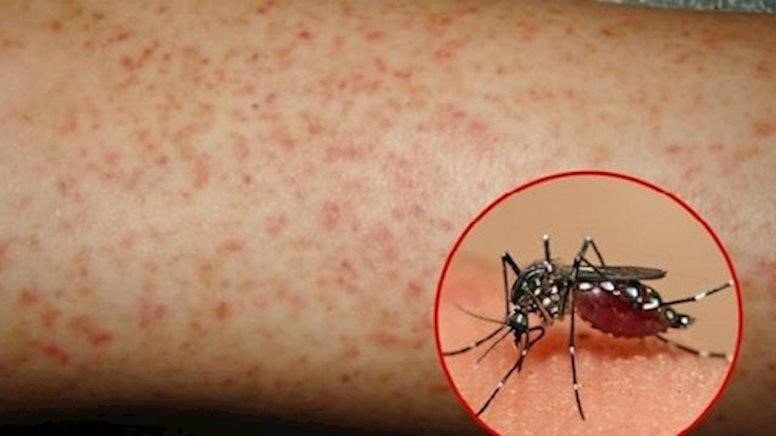 Cảnh giác với biến chứng của bệnh sốt xuất huyết Dengue ảnh 1