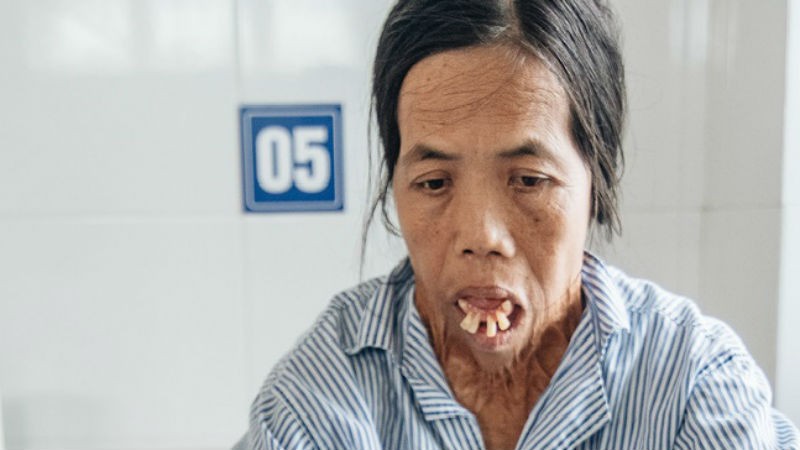Đã gần 50 năm cô Sáu phải sống với khuôn mặt biến dạng vì tai nạn năm 6 tuổi.(Ảnh: Kênh 14).