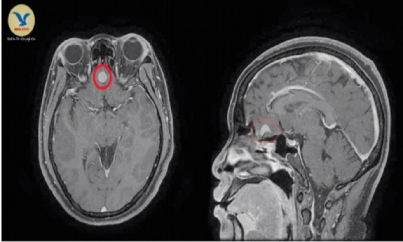 Hình ảnh khối u màng não kích thước khoảng 9x10mm vị trí liềm đại não trước của bệnh nhân T., trên hình ảnh chụp MRI.