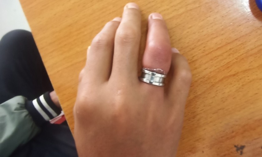 Hình ảnh ngón tay sau đeo nhẫn kim loại 1 ngày. Ảnh: BVCC