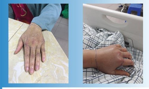 Mu bàn tay bệnh nhân trước và sau khi sử dụng huyết thanh kháng rắn cắn. Ảnh: BVCC