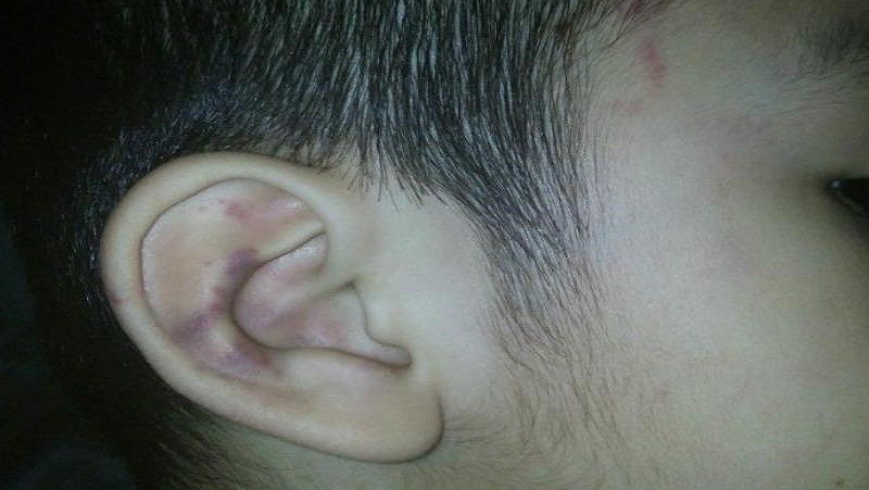Vết thương ở tai bé K. Ảnh PLO