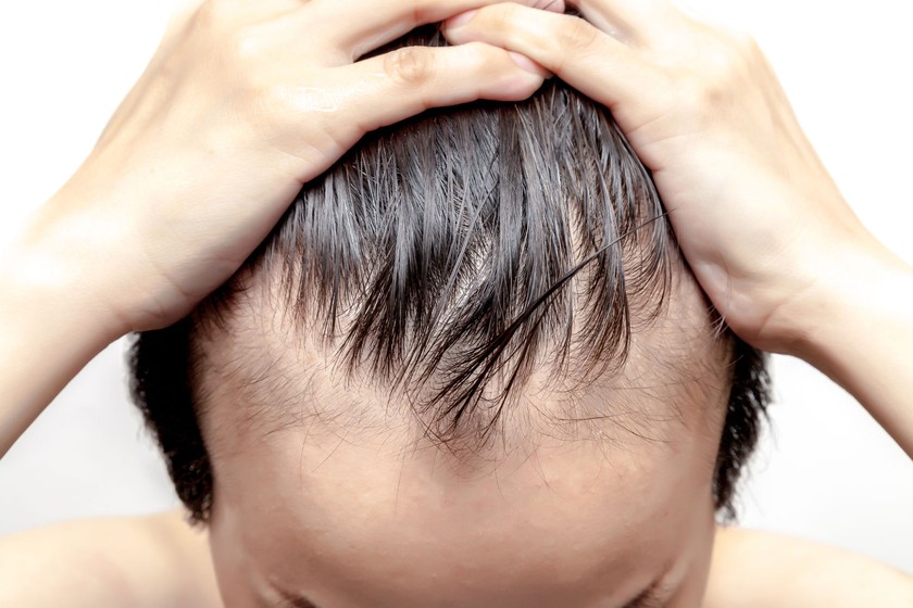 Hói đầu sớm ở nam giới và cách điều trị hói đầu hiệu quả  Báo Dân trí