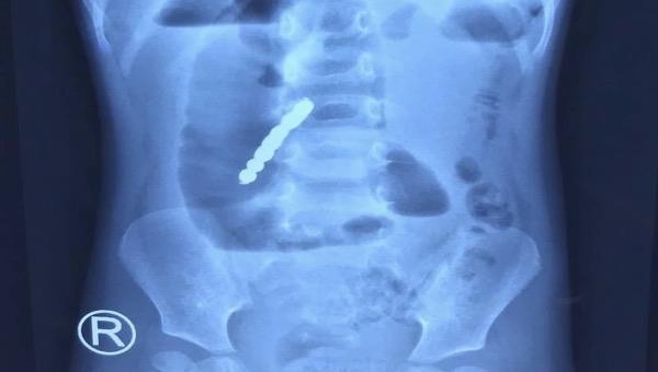 Hình ảnh chụp X-quang dị vật trong ổn bụng bé gái. Ảnh: BVCC