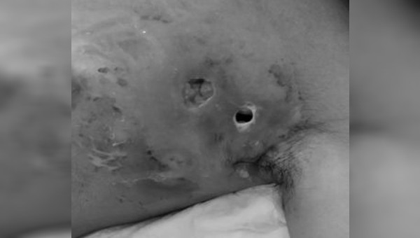 Tổn thương hoại tử trên cơ thể bệnh nhân Hà Văn T. sử dụng thuốc nam đang điều trị tại Bệnh viện Việt Đức. Ảnh: BVCC