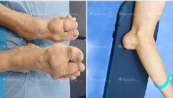 Bệnh Gout Nguyên nhân triệu chứng và cách điều trị