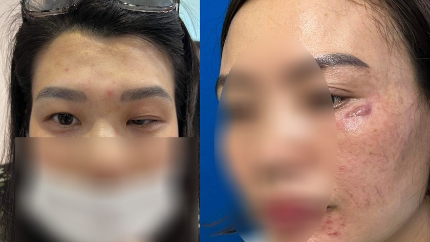 Phồng hàm, xệ mắt, nguy cơ biến chứng kéo dài vì tiêm Botox \'chỗ ...