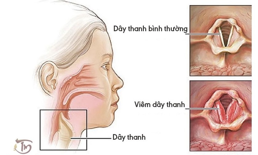 Biến chứng viêm thanh quản ở trẻ có thể đe dọa đến tính mạng | Báo ...