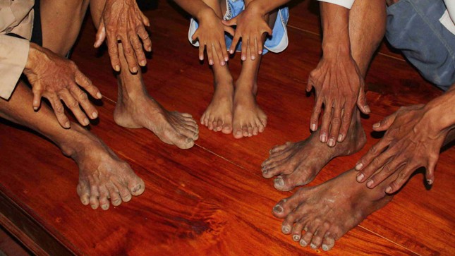 Tất cả các bàn tay và chân những người này đều có 6 ngón.