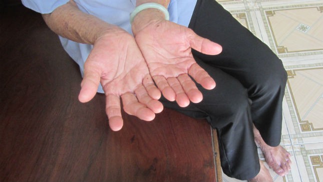 Mười ngón tay không còn dấu vân tay, đôi chân lở loét sau gần 60 năm đi lau nhà thuê