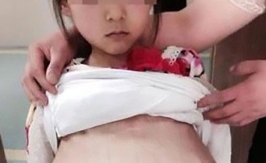 Hình ảnh bé gái 12 tuổi mang thai 3 tháng khi đưa vào bệnh viện ở Từ Châu (Trung Quốc) - Ảnh: Báo Trung Quốc