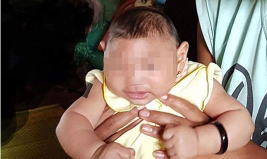 Em bé đầu tiên của Việt Nam nghi mắc chứng đầu nhỏ do vi rut Zika