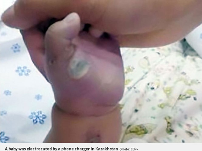 Bức ảnh bàn tay bị cháy xem của bé gái bị tử vong ở Kazakhstan do điện giật khi chơi với điện thoại đang sạc pin