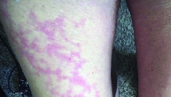 Dấu hiện trên da có thể là cảnh báo sớm của bệnh nhân nhiễm Covid-19