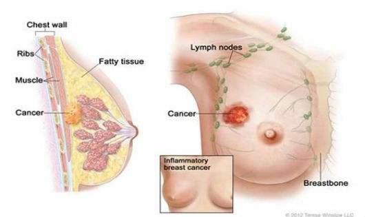 Bác sĩ “mách nước” cách phát hiện sớm ung thư vú ở chị em