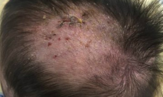 Hình ảnh vùng da đầu tổn thương của cháu bé bị hội chứng mô bào