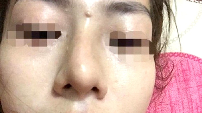Vụ bé gái 13 tuổi tổn hại 42% sức khỏe khi đi nâng mũi: Khôi phục quyền khiếu nại của gia đình bị hại