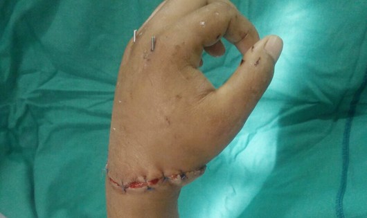 Bàn tay trái bị đứt lìa được phẫu thuật nối liền thành công