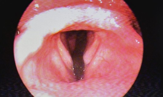 Hình ảnh con đỉa bám trong cổ họng cụ bà 72 tuổi (ảnh chụp từ máy nội soi)