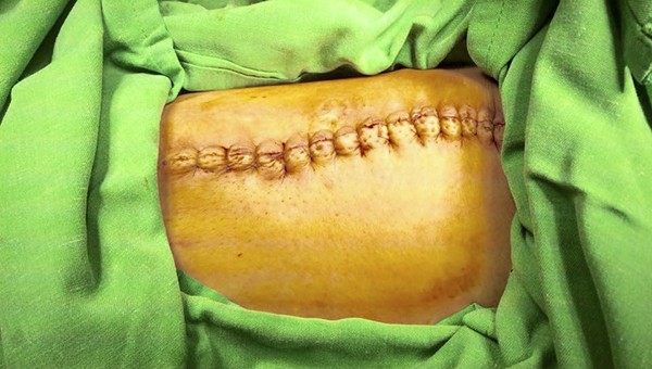 Sau khi phẫu thuật khối u nặng 2kg trên đùi, bệnh nhân khỏe mạnh, thoải mái