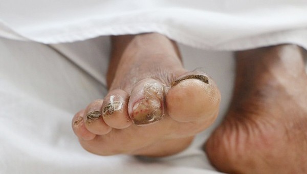 Hai đầu ngón chân bị sưng phù do mắc khuẩn "ăn thịt người"