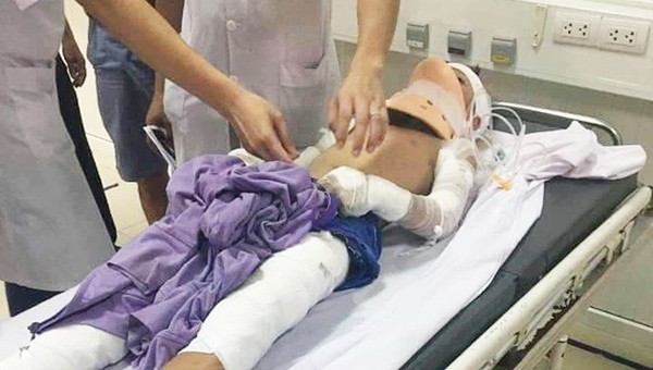 Bé trai 12 tuổi bị bỏng nặng do bị phóng điện phải tháo hai cánh tay.