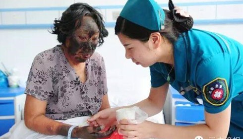 Khuôn mặt bà lão bị cháy đen thui. (Nguồn: Chinadaily.com.cn)