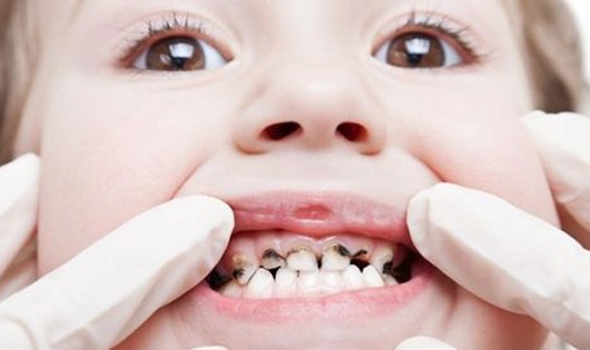 4 thói quen của người lớn vô tình gây bệnh răng miệng cho trẻ
