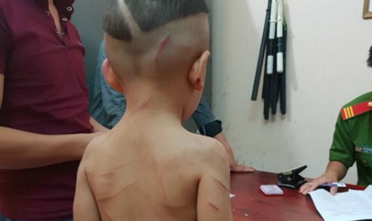 Bé trai 3 tuổi  bị đánh tàn nhẫn.