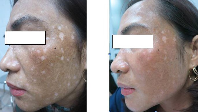 Sau một tháng có da đẹp như Ngọc Trinh, nữ bệnh nhân bắt đầu xuất hiện các đốm trắng, đen trên da.