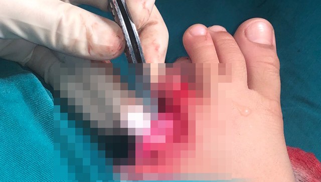 Bé trai 6 tuổi bị 'tấm ốp sành điệu' xe Air Blade cắt đứt 2 ngón chân 