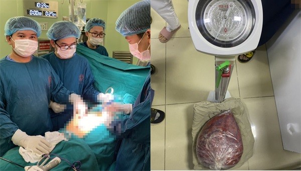 Bác sĩ Triệu Văn Trường và ekip đã phẫu thuật thành công khối u 10kg trong ổ bụng nữ bệnh nhân. Ảnh: Bệnh viện Bạch Mai.