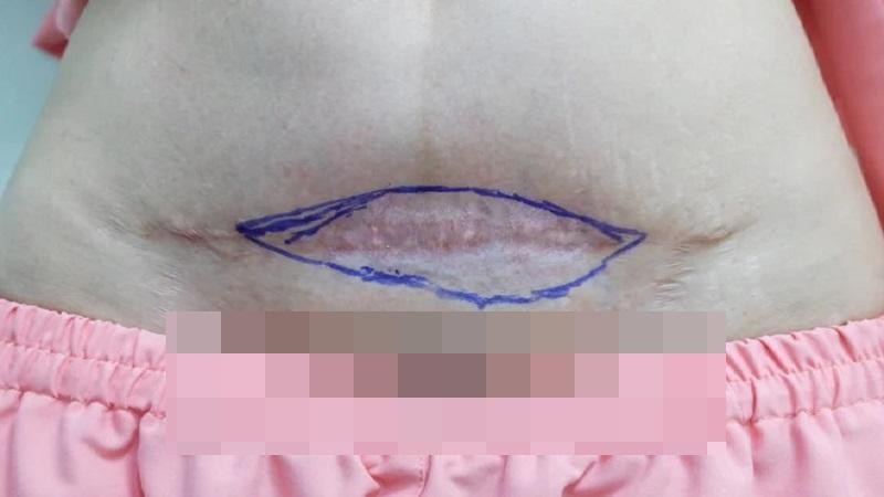 Da bụng chị L bị sẹo lồi sau khi trị sẹo tại spa Ảnh: BSCC