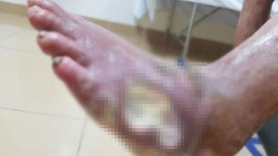 Vết loét bàn chân của người bệnh - Ảnh: BVCC