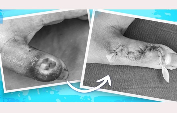 Hình ảnh ngón tay của bệnh nhi trước và sau khi được điều trị (ảnh BVSN)