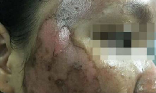 Một nạn nhân bị phỏng và tổn thương da nghiêm trọng sau khi đến spa lột, tẩy da bằng thuốc bắc.