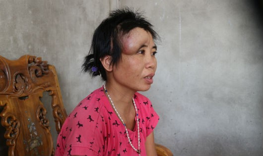 Vì không có tiền phẫu thuật nên khối u trên mặt chị Sang ngày càng lớn