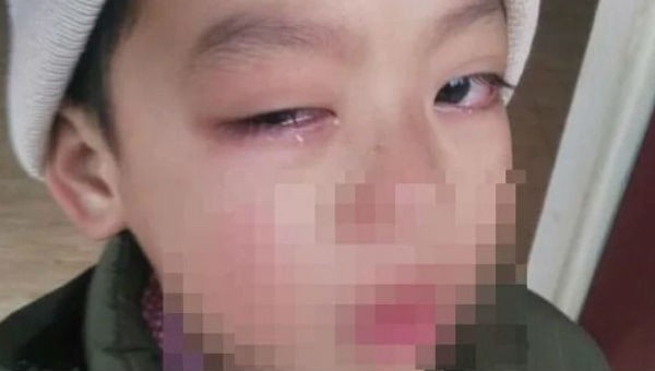 Mắt học sinh thương tích bị cho do cô giáo đánh