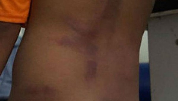 Một em học sinh nghi bị bạo hành với chi chít vết bầm tím trên người.