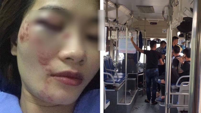 Nữ nhân viên xe buýt bị 4 thanh niên hành hung đánh nhập viện