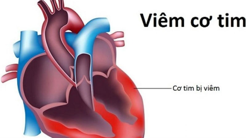 Thực hư virus viêm cơ tim gây chết người