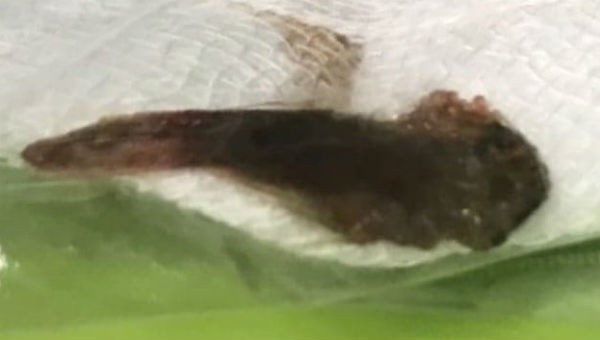 Con cá da trơn được gắp ra từ phế quản của bệnh nhân
