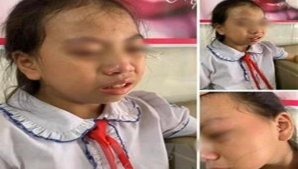 Hình ảnh nữ sinh bị giáo viên tát vào má được người nhà học sinh đưa lên mạng xã hội.