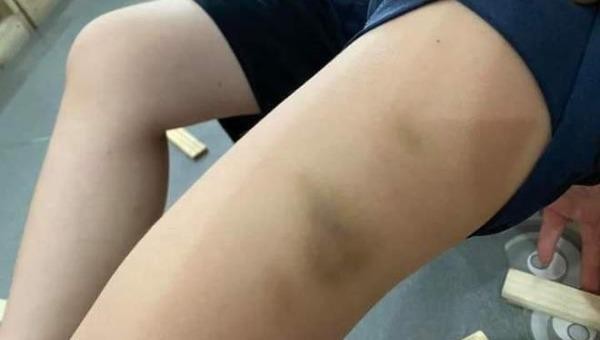Vết bầm tím trên đùi học cháu bé nghi bị cô giáo đánh.